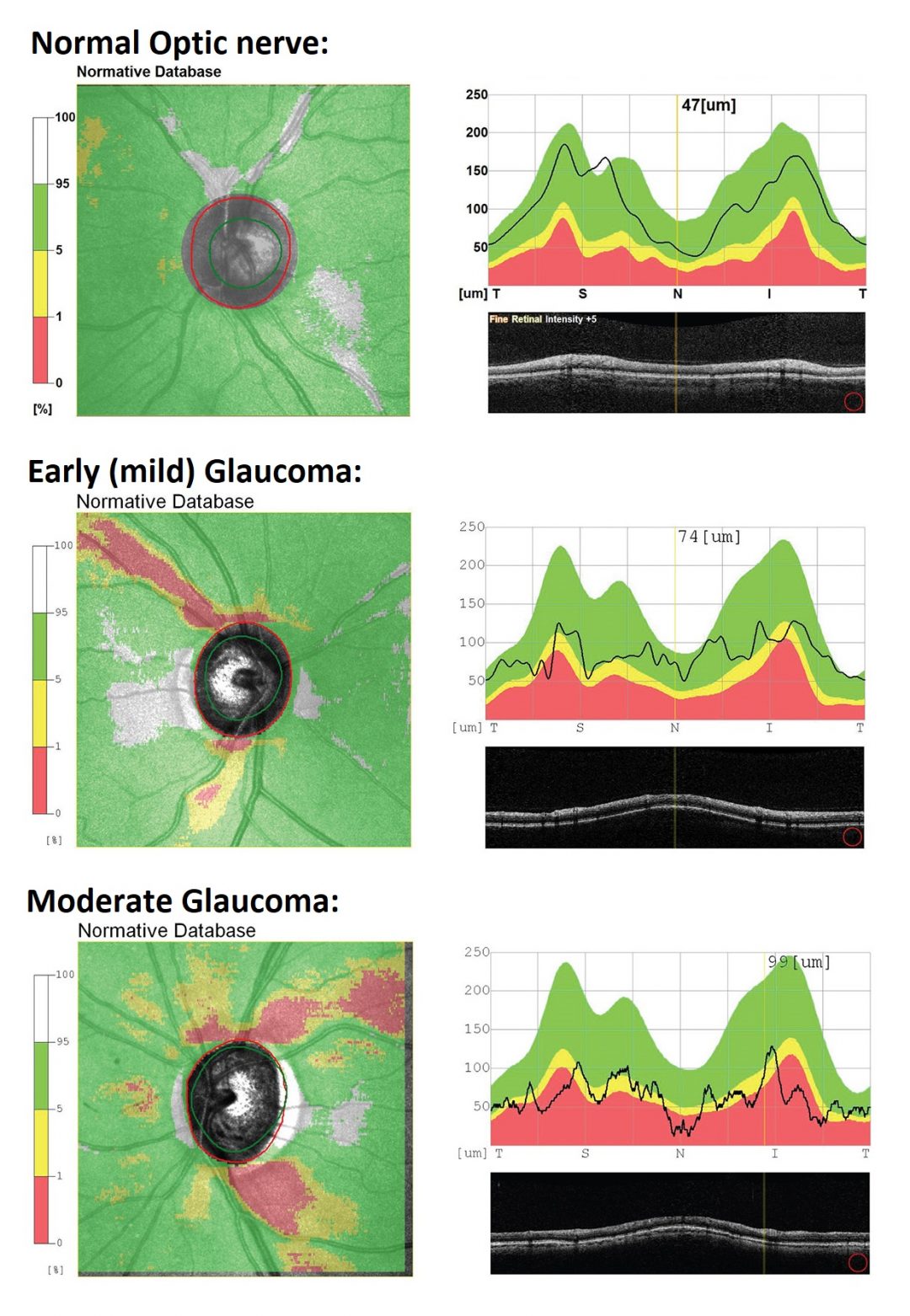 Glaucoma Grace Vision Optometrist Brisbane