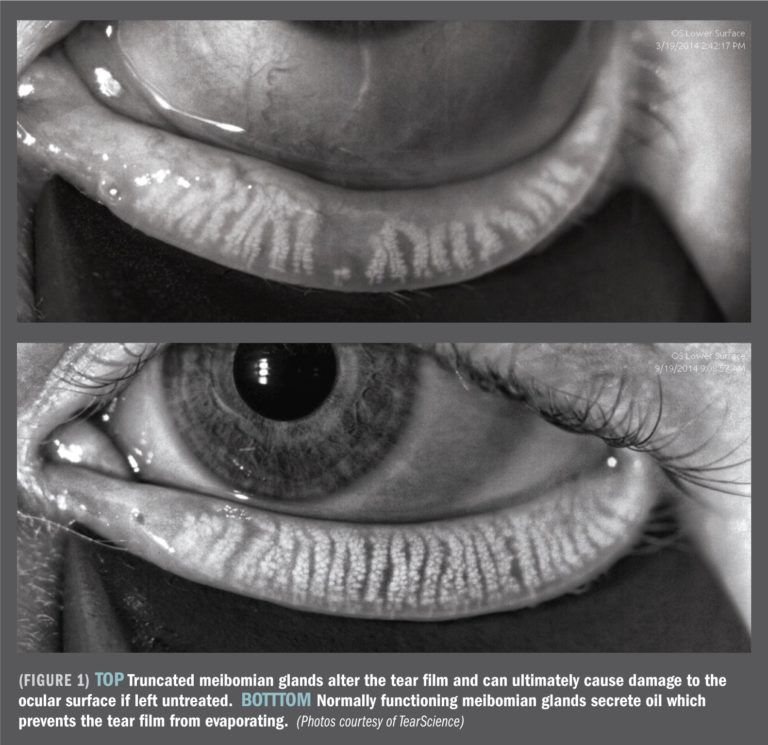 Dry Eye Assessment | Grace & Vision Optometrist