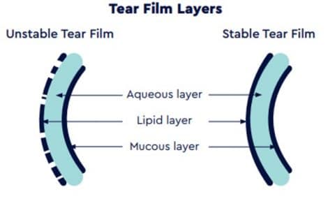 Ipl: Pioneering Dry Eye Treatment