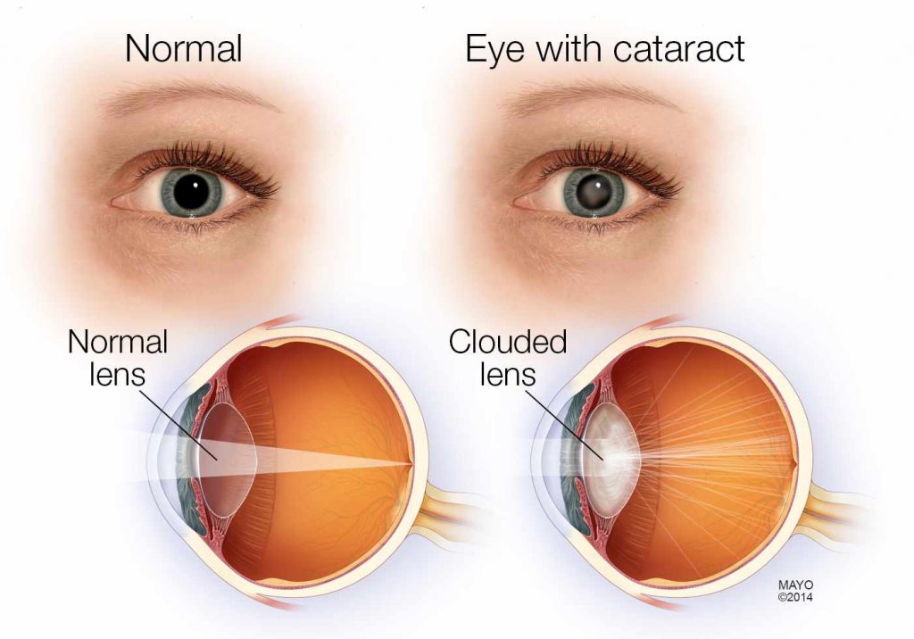 Cataracts Grace And Vision Optometrist Brisbane